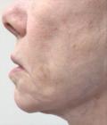 After Results for Sculptra