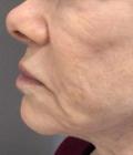 Before Results for Sculptra