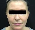 After Results for Sculptra