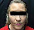 Before Results for Sculptra