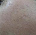 After Results for Subcision
