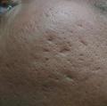 Before Results for Subcision