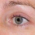 After Results for Thermage