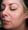 After Results for Thermage