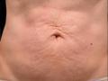 After Results for Thermage