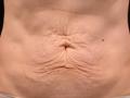 Before Results for Thermage
