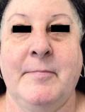 After Results for Vbeam Laser