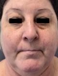 Before Results for Vbeam Laser
