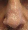 After Results for Vbeam Laser