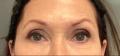 After Results for Voluma