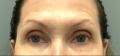 Before Results for Voluma