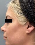 Before Results for Voluma