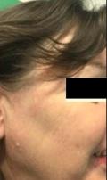 After Results for Yag Laser