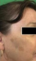 Before Results for Yag Laser