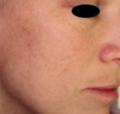 After Results for Yag Laser
