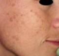 Before Results for Yag Laser