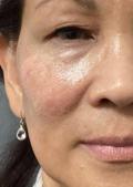 After Results for Yag Laser