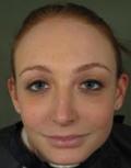 Before Results for Juvederm