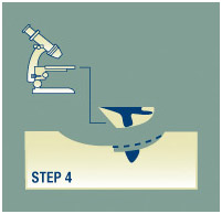 Mohs Surgery Step 4