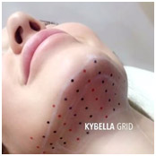 Kybella Grid