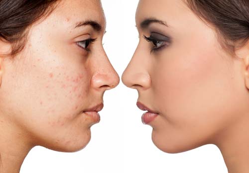Microneedling with PRP Results
