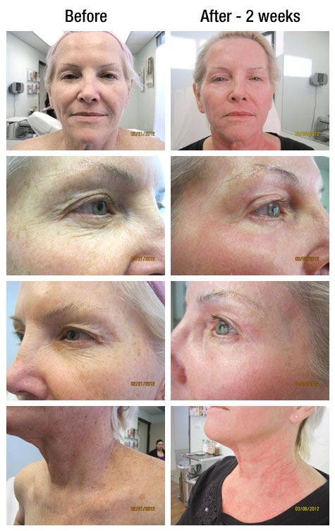 Co2 Skin Resurfacing Valencia Skin Rejuvenation Santa Clarita Skin Care Lancaster