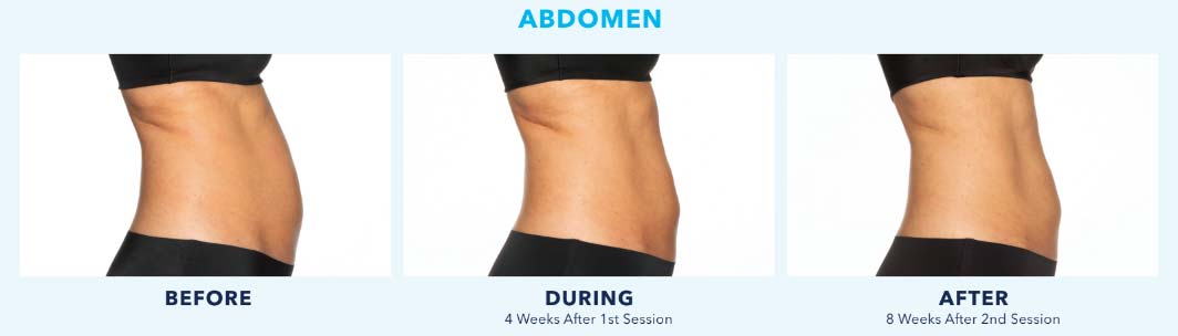 Coolsculpting Results