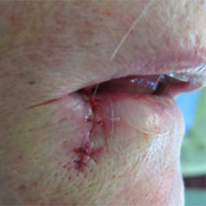 Mohs Before & After Case