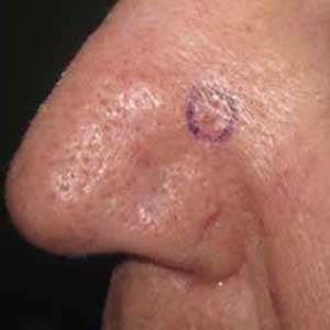 Mohs Before & After Case