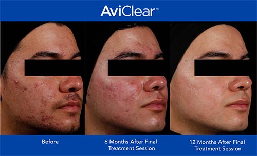 AviClear before and after results