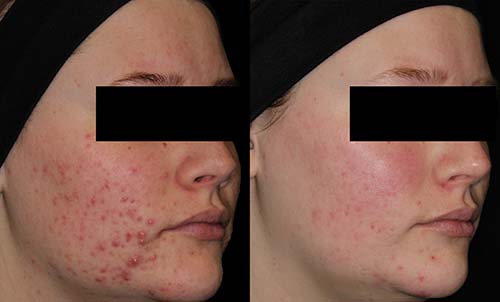 AviClear before and after results