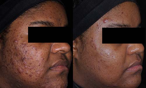 AviClear before and after results