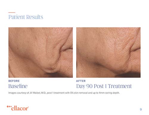 Ellacor before and after results