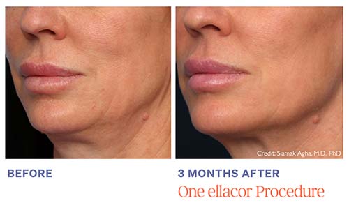 Ellacor before and after results