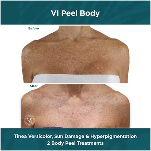 VI PEEL body results