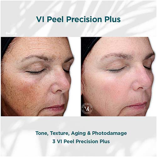 VI PEEL face results