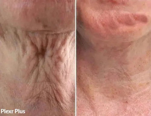 Plexr Before & After Photo