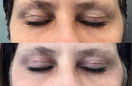 Plexr Before & After Photo