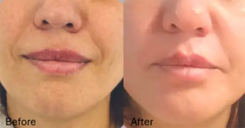 Plexr Before & After Photo