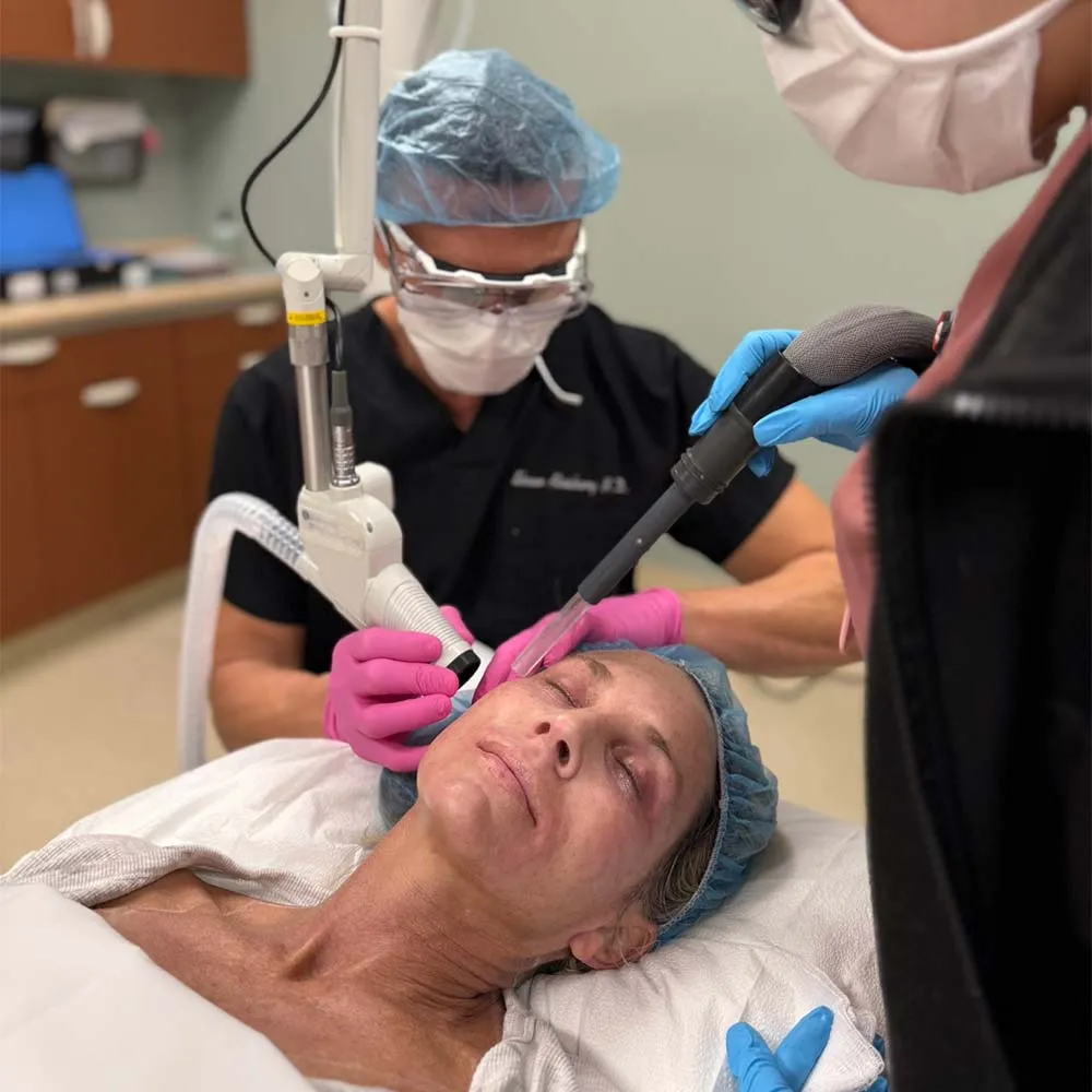 CO2 Skin Resurfacing in Santa Clarita