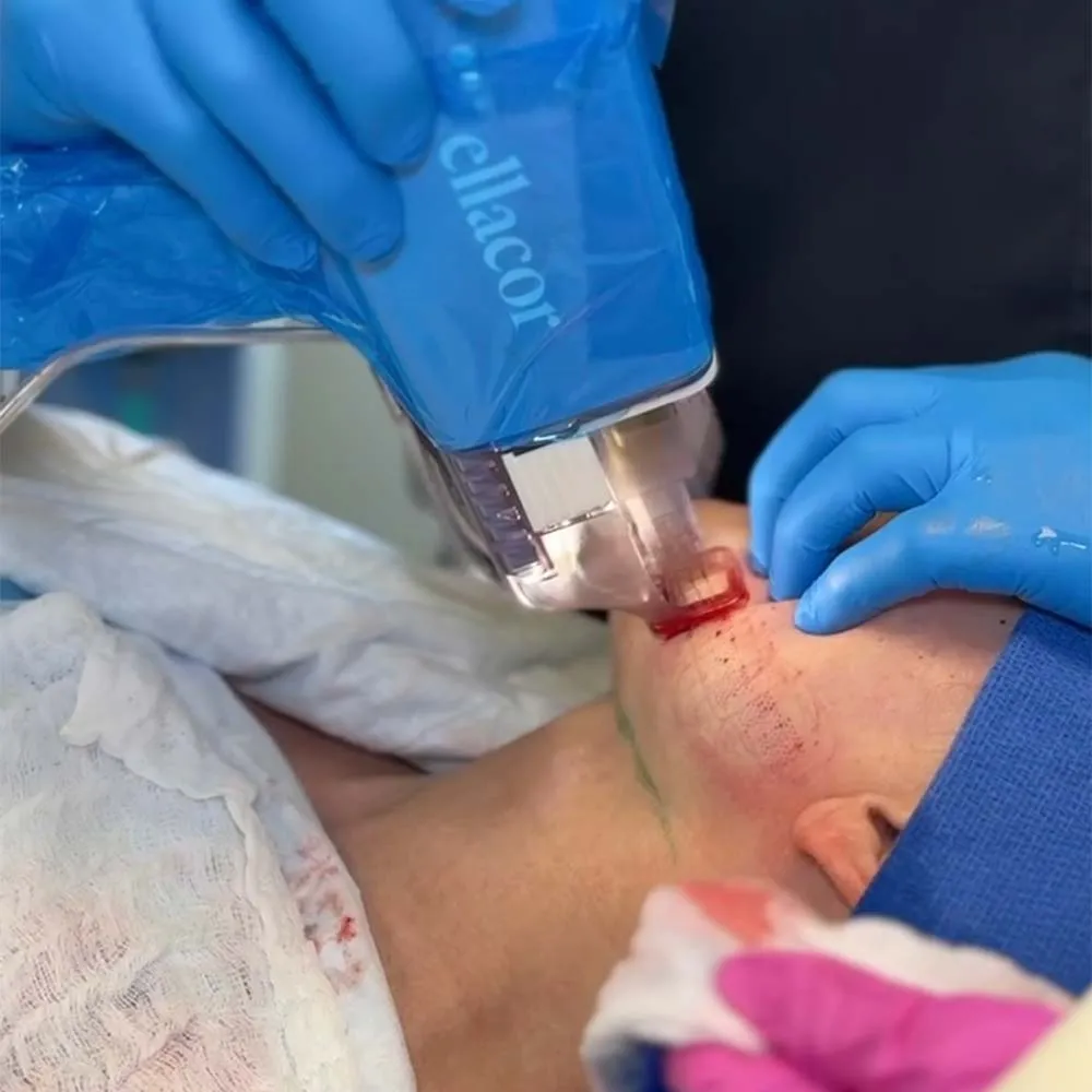 Ellacor® in Santa Clarita