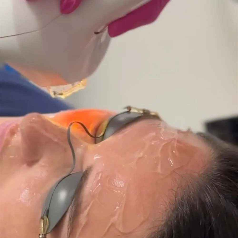 Intense Pulsed Light Therapy (IPL) in Santa Clarita
