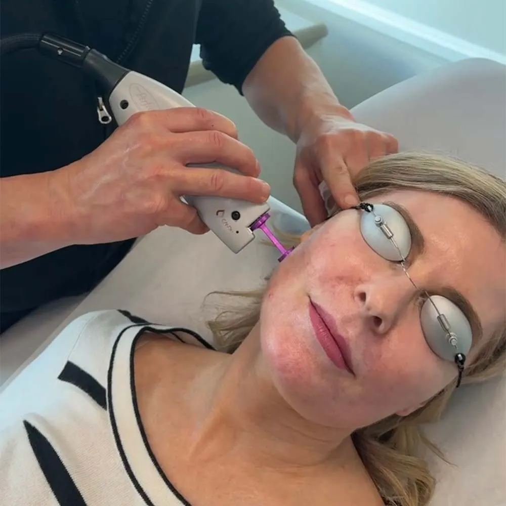 V-Beam Laser in Santa Clarita