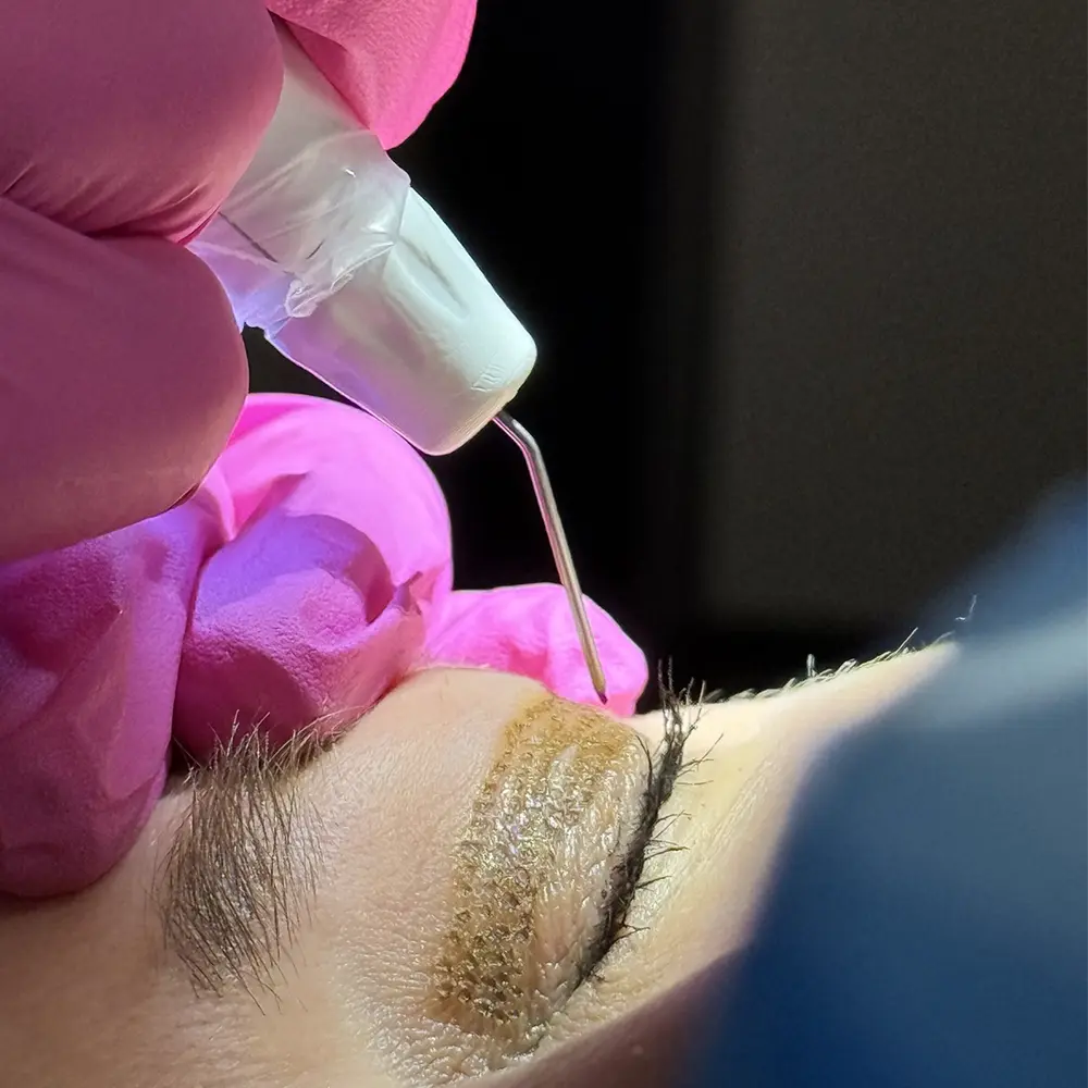 Plexr Plasma Resurfacing in Santa Clarita